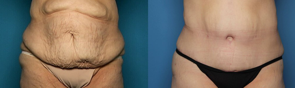 Tummy Tuck Recovery  Healing Stages And Tips-Modified 2024