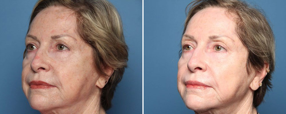 Before and after chemical peel