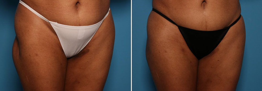 Before and after fat transfer