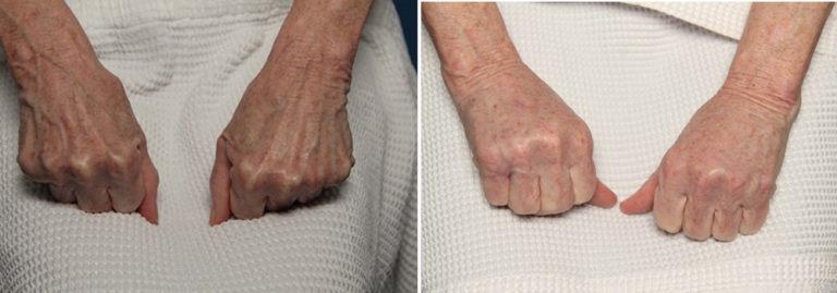 Before and after hand rejuvenation
