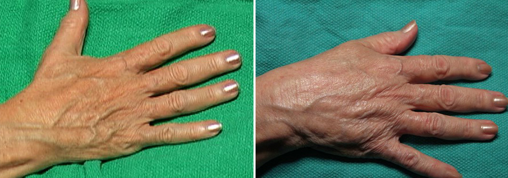 Before and after hand rejuvenation