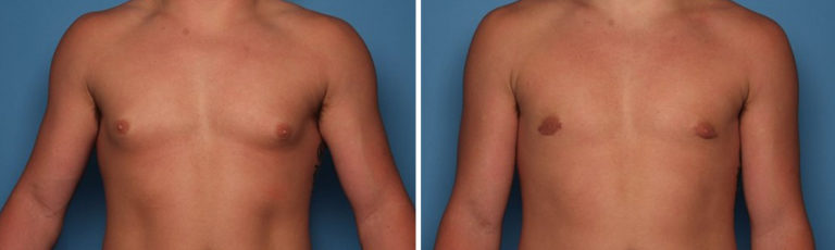 Before and after gynecomastia