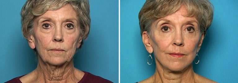 Before and after necklift
