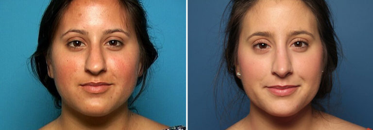 Before and after rhinoplasty