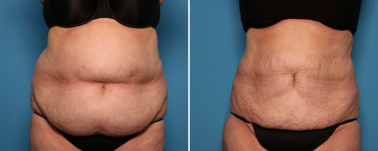 Before and after liposuction
