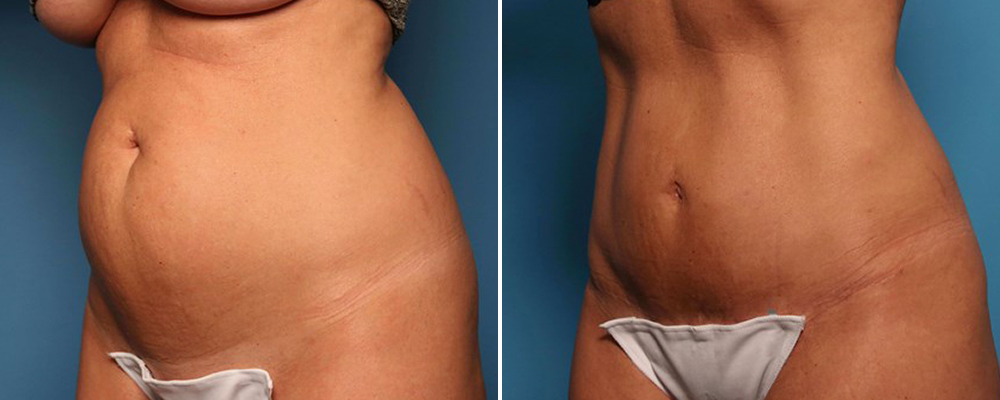 Before and after Liposuction
