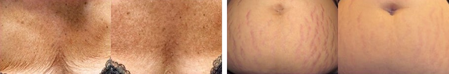 PRX Derm Perfexion Before and After Pictures