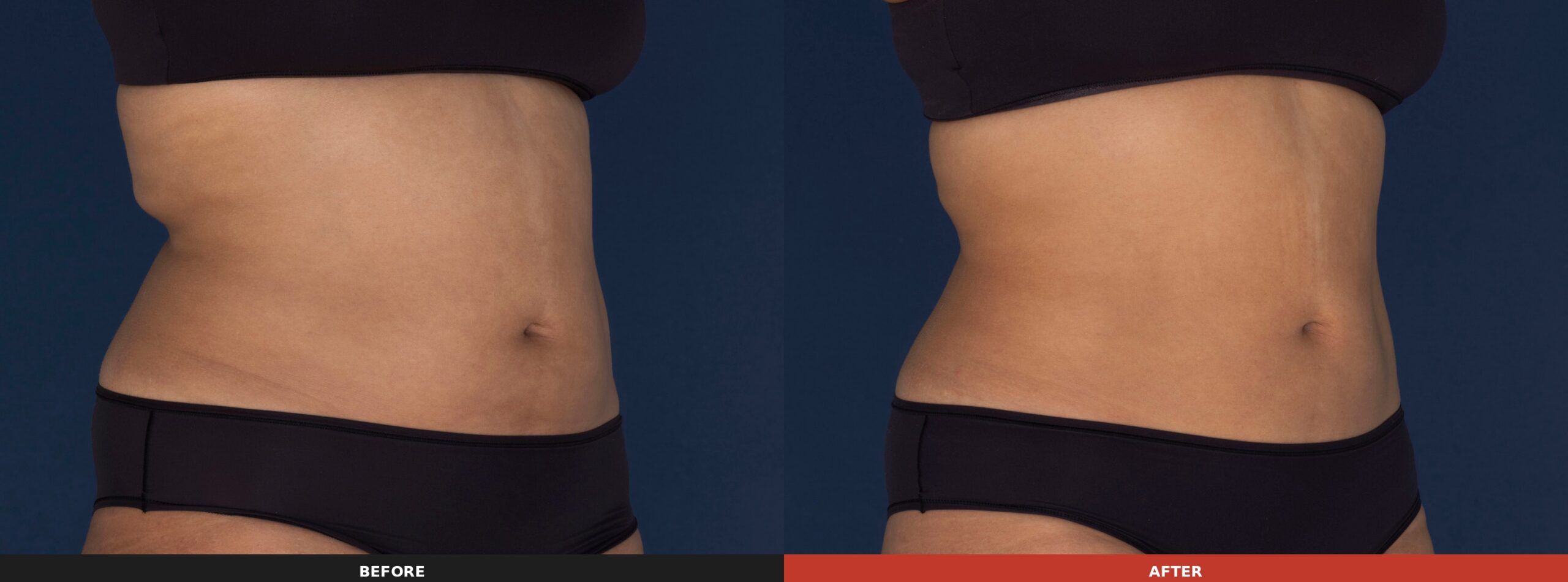 Abdomen & Flanks (Front View) — Results 26 weeks after 1 treatment on the flanks and 17 weeks after 2 treatments on the abdomen. Results may vary.