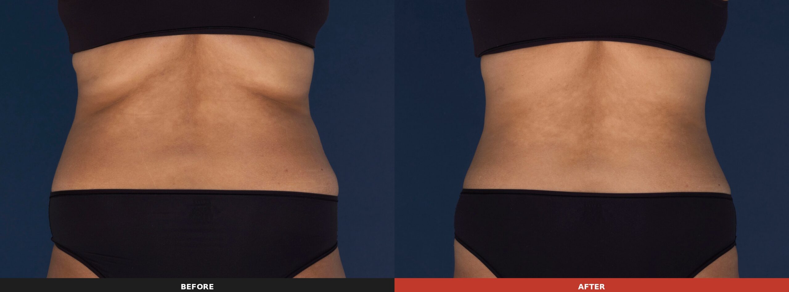 Abdomen & Flanks (Side View) — Results 26 weeks after 1 treatment on the flanks and 17 weeks after 2 treatments on the abdomen. Results may vary.