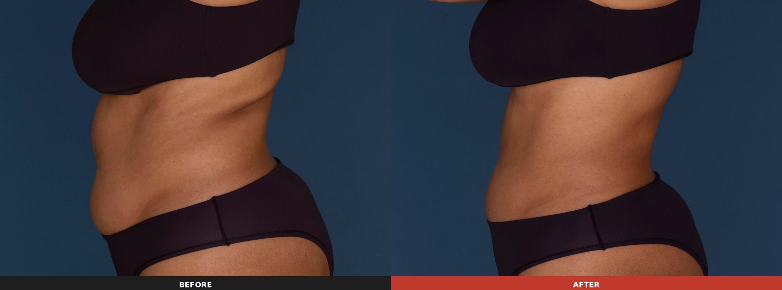 Abdomen & Flanks (Side View) — Results 14 weeks after 2 treatments on the abdomen and 9 weeks after 3 treatments on the flanks. Results may vary.