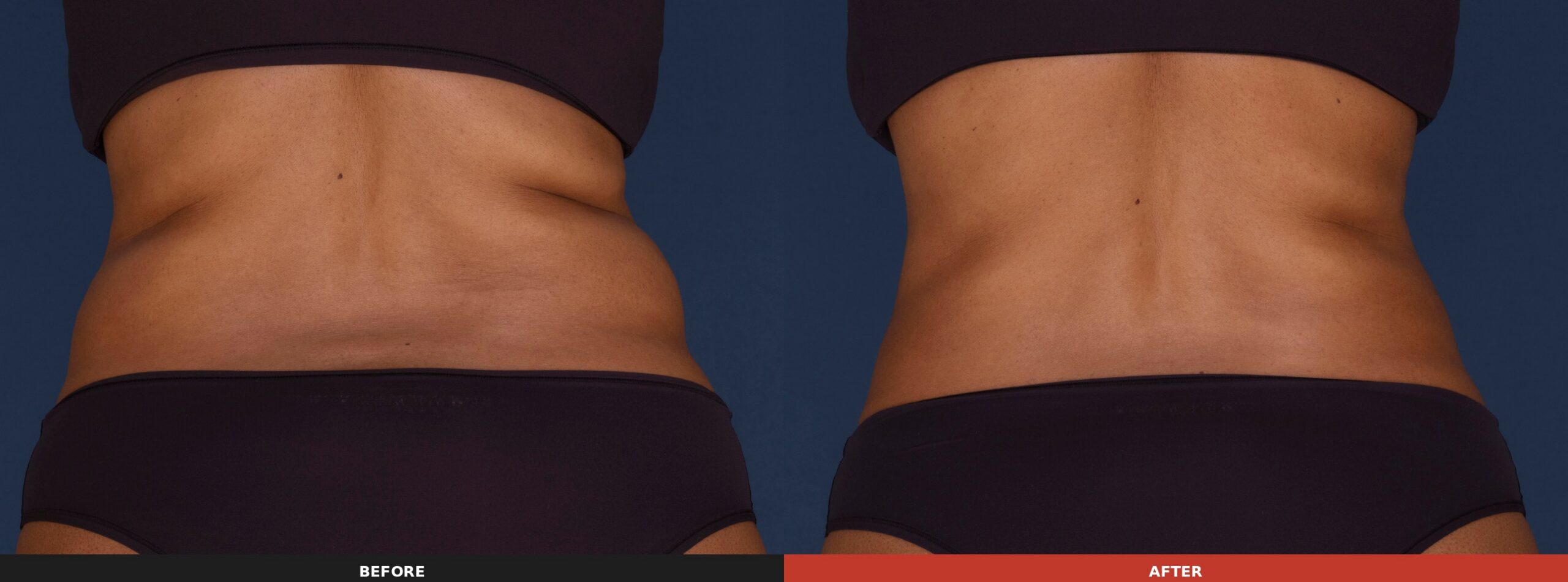 Abdomen & Flanks (Back View) — Results 14 weeks after 2 treatments on the abdomen and 9 weeks after 3 treatments on the flanks. Results may vary.