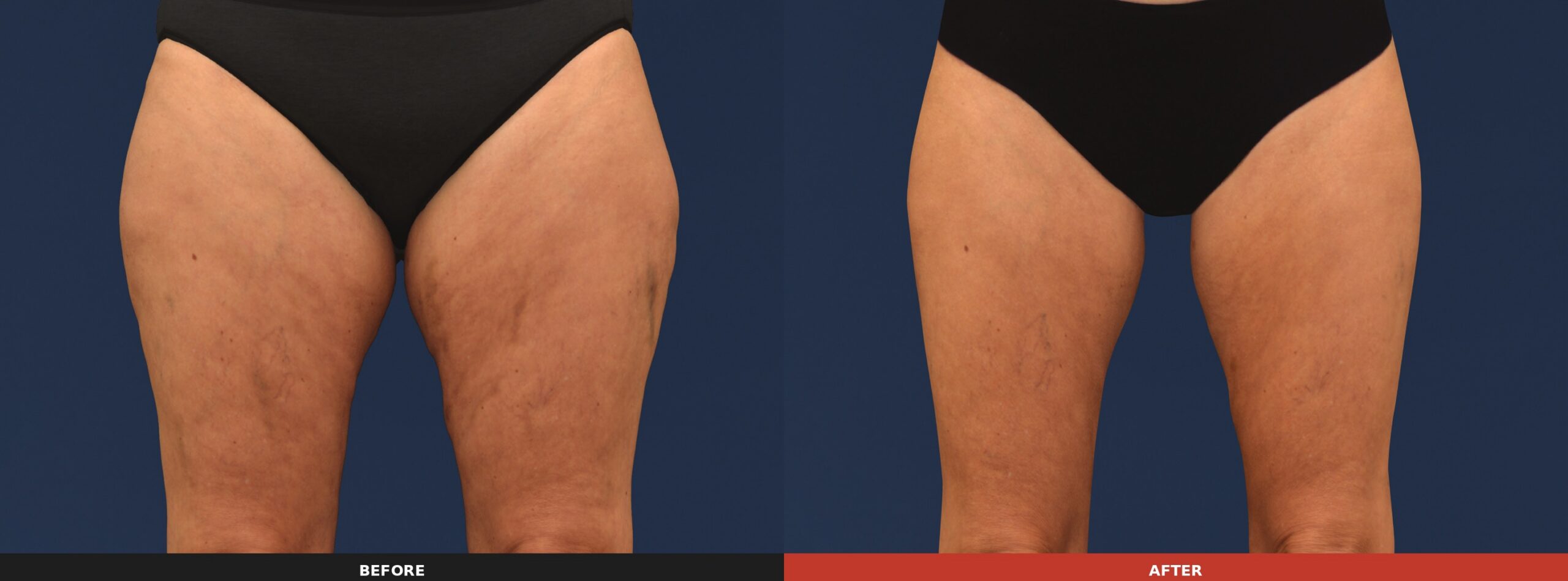 Inner & Outer Thighs — Results 16 weeks after 3 treatment visits. Results may vary.