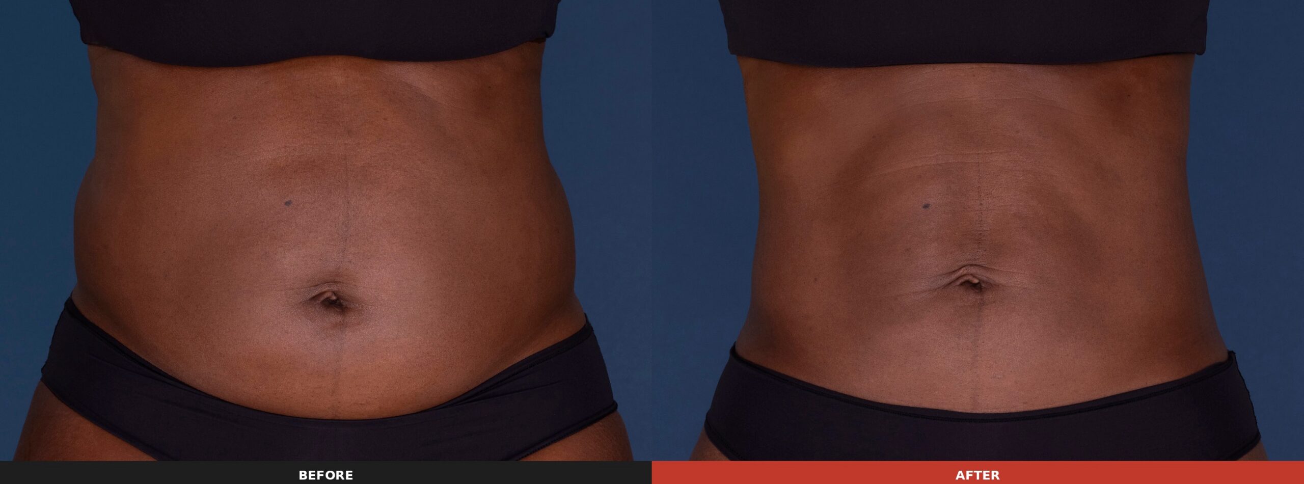 Abdomen, Flanks, Back Fat & Bra Fat (Front View) — Results 12 weeks after 3 CoolSculpting® Elite treatments. Results may vary.