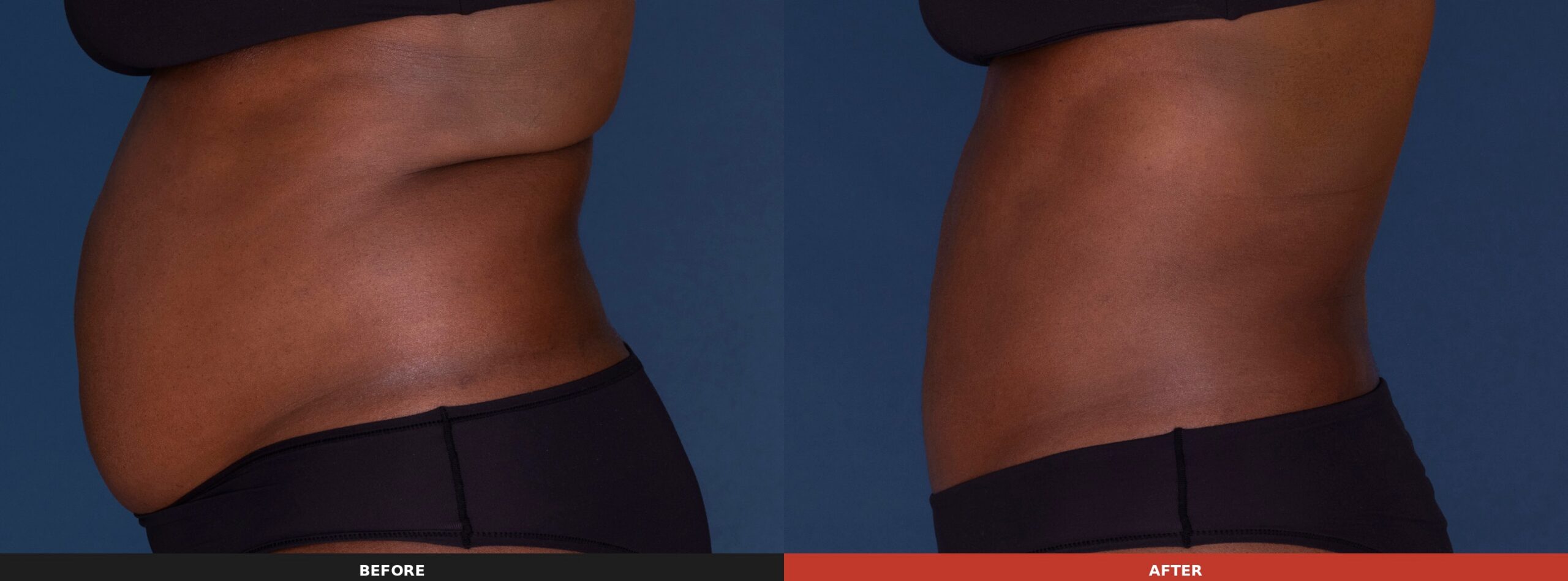 Abdomen, Flanks, Back Fat & Bra Fat (Side View) — Results 12 weeks after 3 CoolSculpting® Elite treatments. Results may vary.