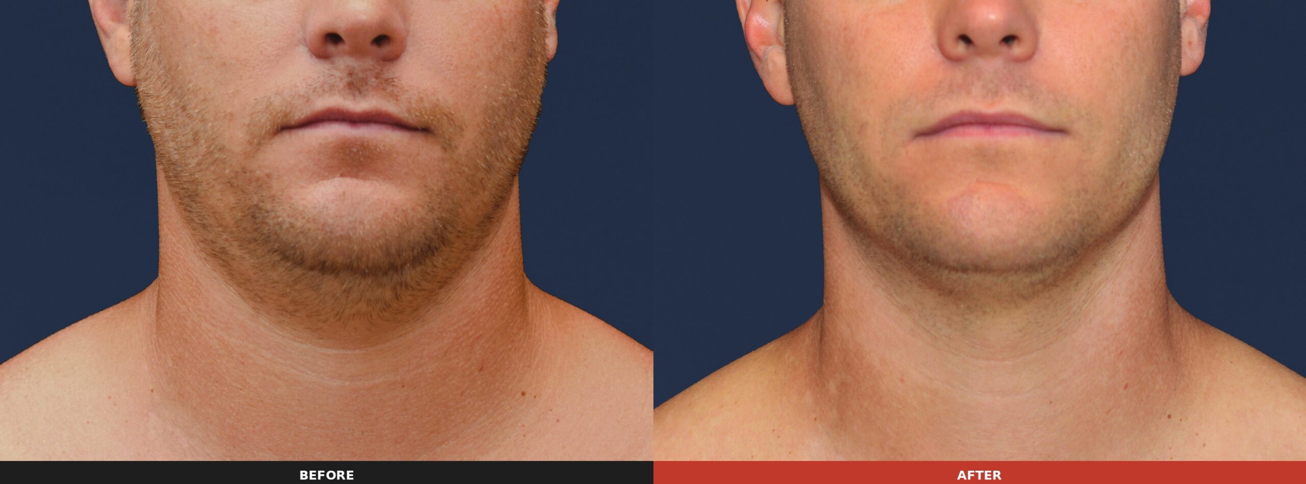 Under the Chin (Front View) — Results 16 weeks after 3 treatment visits. Results may vary.