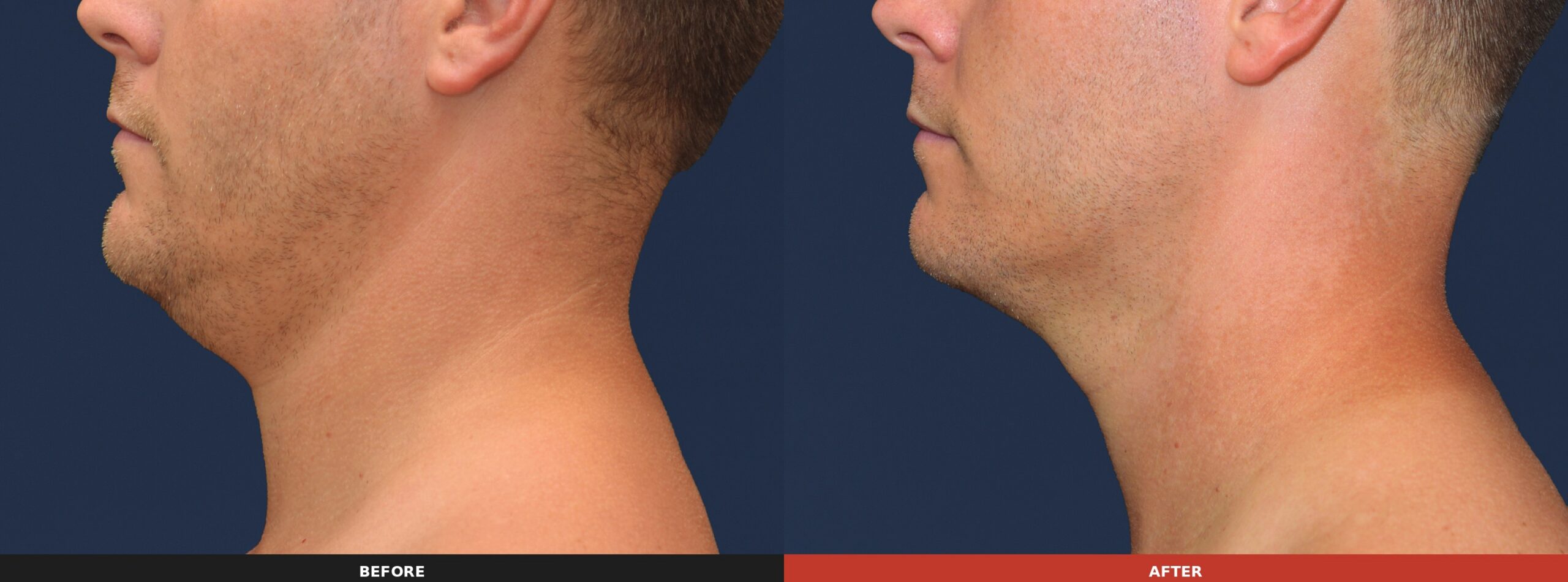 Under the Chin (Side View) — Results 16 weeks after 3 treatment visits. Results may vary.