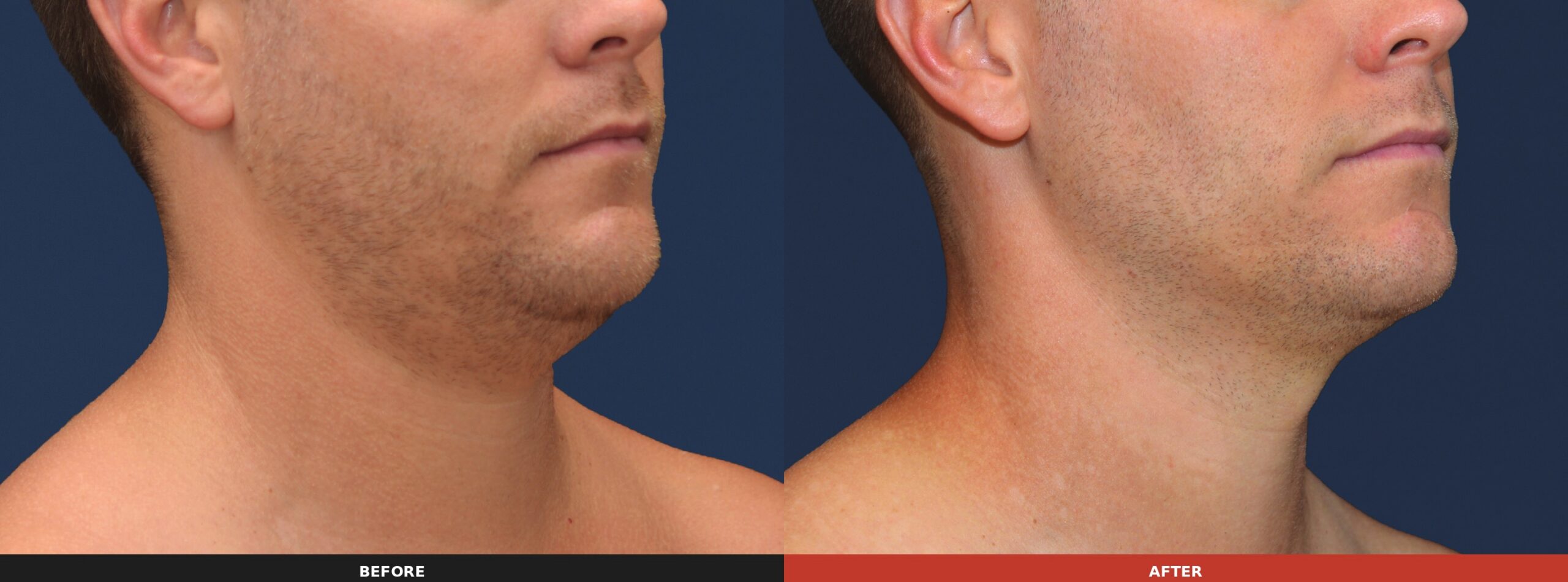 Under the Chin (Side View) — Results 16 weeks after 3 treatment visits. Results may vary.