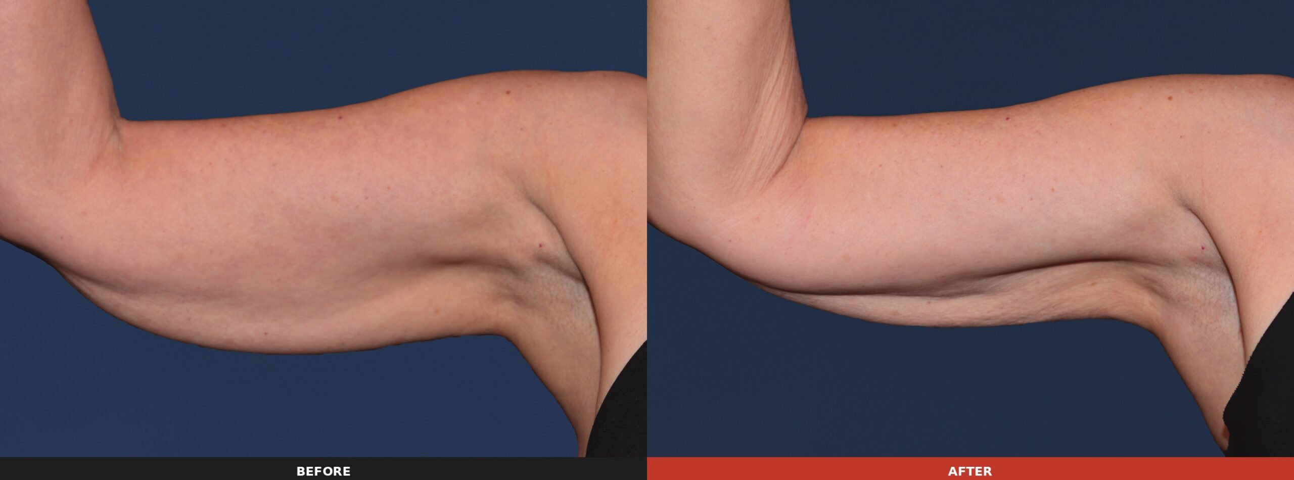 Upper Arm — Results 16 weeks after 2 treatment visits. Results may vary.
