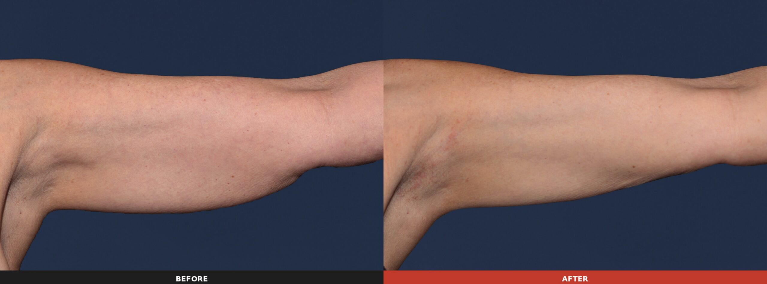 Upper Arm — Results 16 weeks after 2 treatment visits. Results may vary.